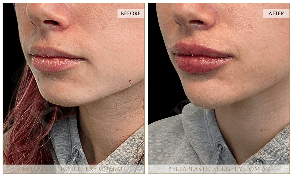 Lower Face Treatment - 1