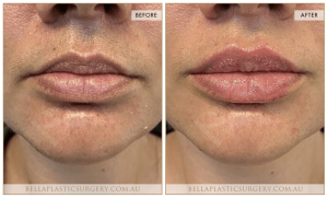 'Kiss Me' Lip Augmentation 07 - 5
