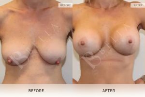 Breast Lift (Mastopexy) + Implants Patient 01 - 1