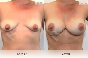 Breast Lift (Mastopexy) + Implants Patient 04 - 4