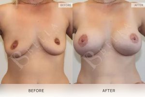 Breast Lift (Mastopexy) + Implants Patient 07 - 7