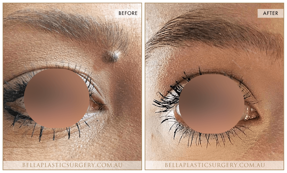 Laser Mole Removal - 1