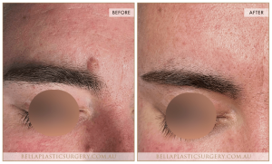 Laser Mole Removal 02 - 3