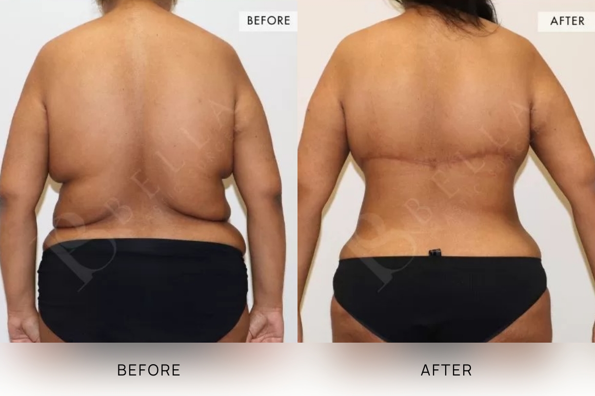 Upper Body Lift (Bra Lipectomy) Sydney - 1