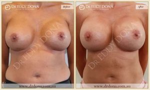 Breast Augmentation 26 - 25