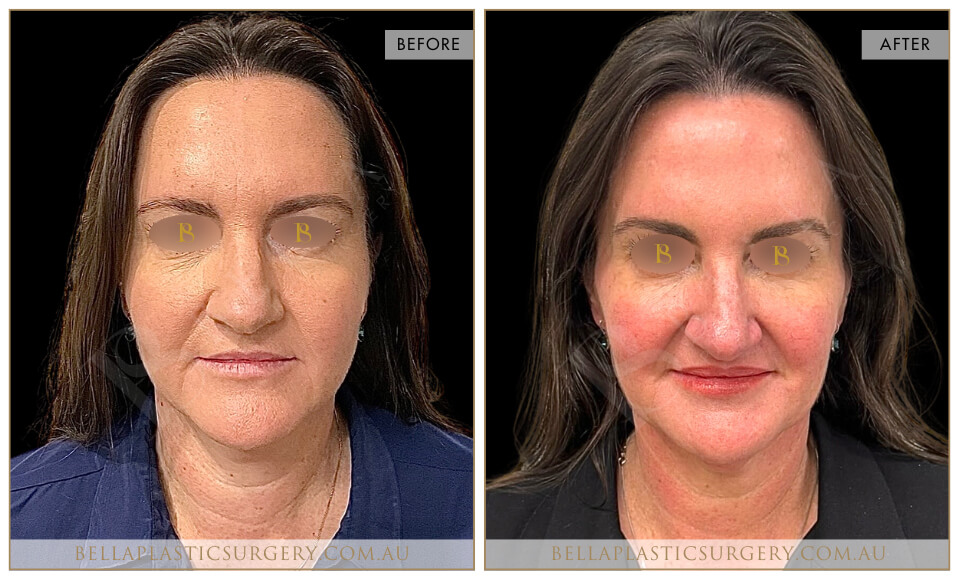 Liquid face lift, before and after 1