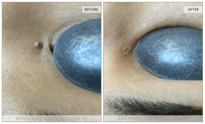 Laser Mole Removal 03 - 4
