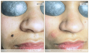 Laser Mole Removal 04 - 5