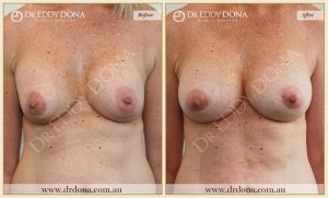 Revision Breast Patient 22 - 16