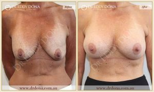 Revision Breast Patient 15 - 8