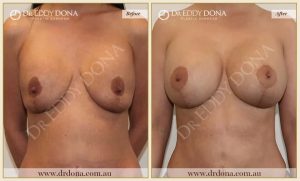 Revision Breast Patient 18 - 11