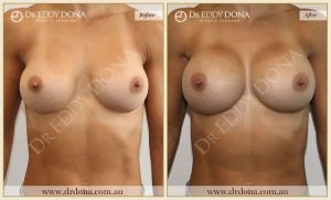 Revision Breast Patient 14 - 7