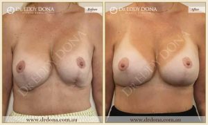 Revision Breast Patient 19 - 12