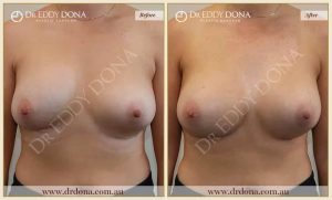 Revision Breast Patient 20 - 14