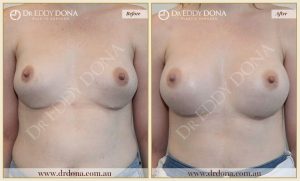 Revision Breast Patient 13 - 6