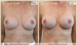 Revision Breast Patient 16 - 9