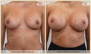 Revision Breast Patient 17 - 10