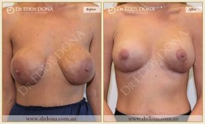 Revision Breast Patient 7 - 21