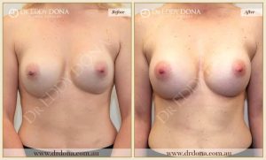 Revision Breast Patient 8 - 22
