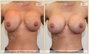 Revision Breast Patient 5 - 19