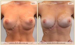 Revision Breast Patient 2 - 13