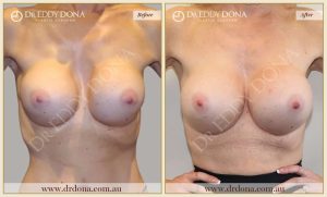 Revision Breast Patient 6 - 20
