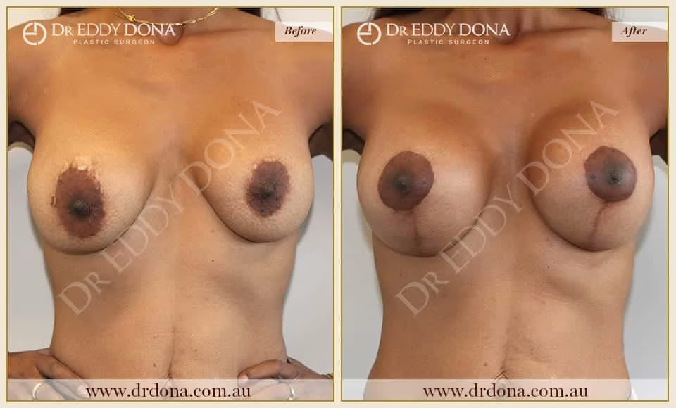 Breast Revision Surgery - 1