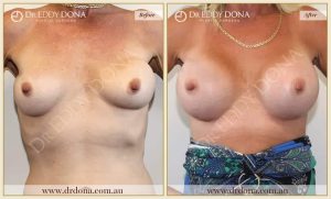 Revision Breast Patient 3 - 17