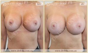 Revision Breast Patient 11 - 4