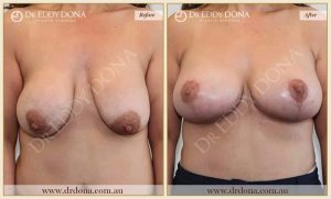Revision Breast Patient 12 - 5