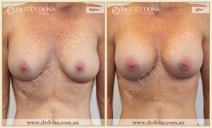 Revision Breast Patient 10 - 3