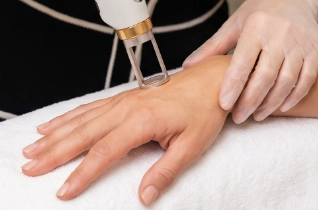 Hand Rejuvenation – Bella Plastic Surgery Sydney