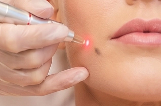 Laser Pigmented Birthmarks Removal - 1