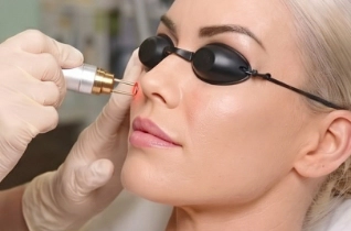 Laser Red Vascular Lesion Removal - 1