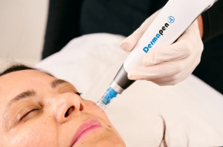 Skin Needling Treatment – Bella Plastic Surgery Sydney